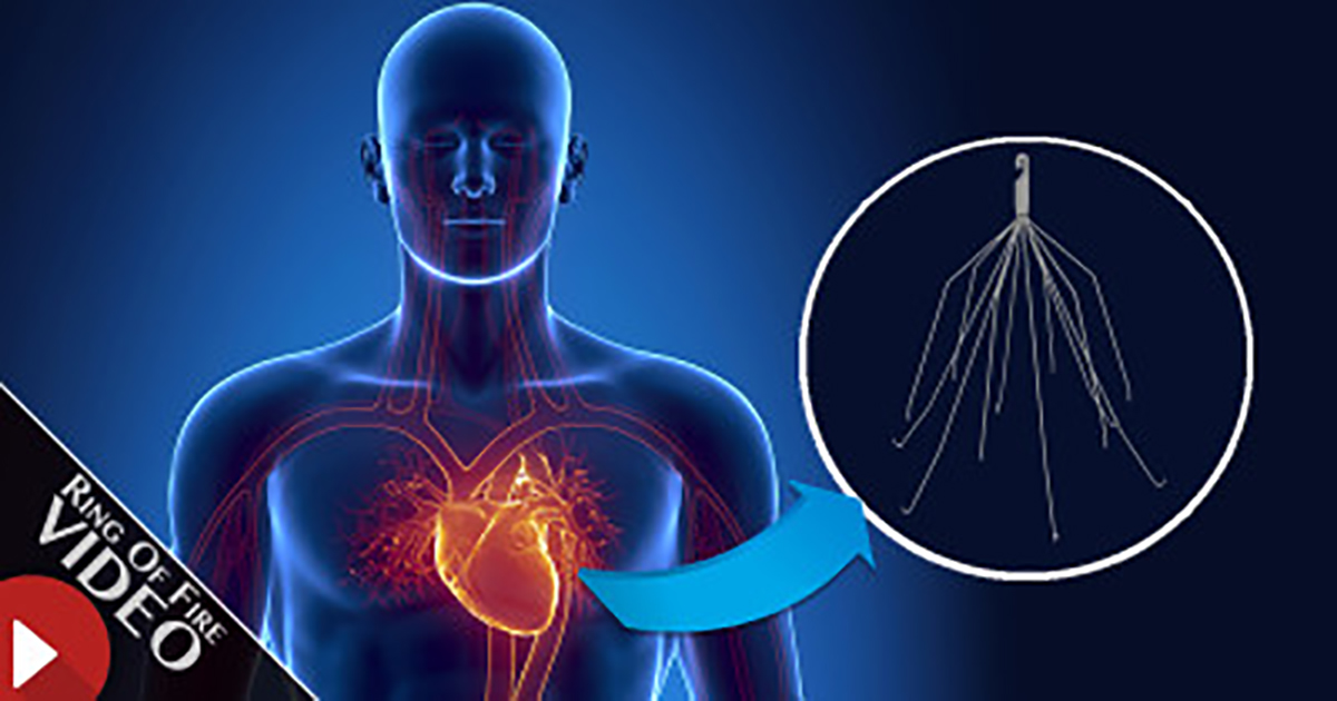 IVC Filter Lawsuits Arise From the High Failure Rate and Severe Injuries