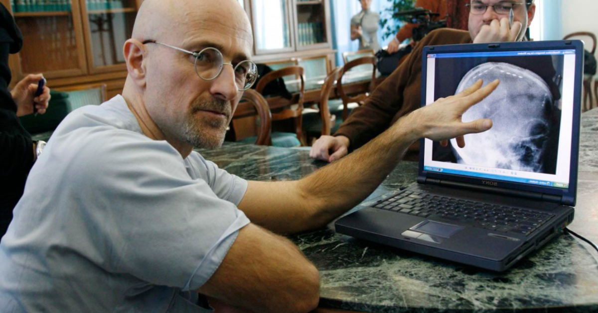 Hope for TEABAGGERS: First Complete Human Head Transplant by 2017, Just Hold On!