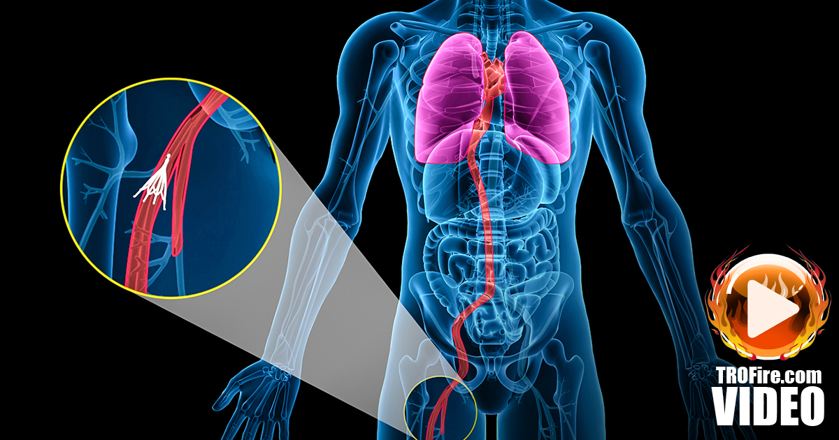 Are IVC Blood Filters Causing More Harm Than Good? – The Ring of Fire