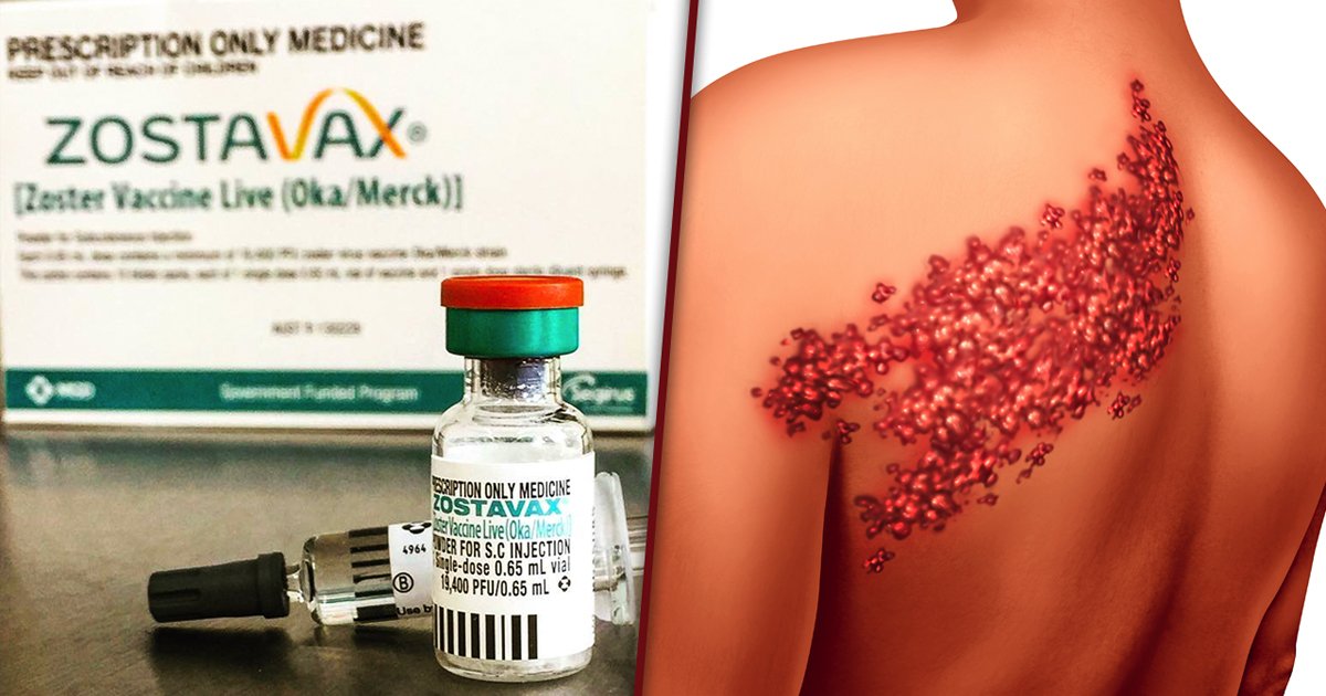 Shingles Vaccine Zostavax Is Causing What It’s Designed To Prevent